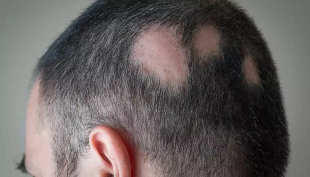 Pattern baldness (alopecia areata) affects approximately 1.7 per cent of the population and we still don’t know precisely what causes it. (Photo: Shutterstock)
