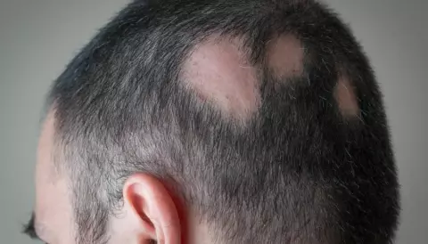 Pattern hair loss could be due to gut bacteria