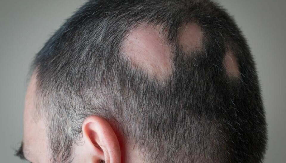 Pattern baldness (alopecia areata) affects approximately 1.7 per cent of the population and we still don’t know precisely what causes it. (Photo: Shutterstock)