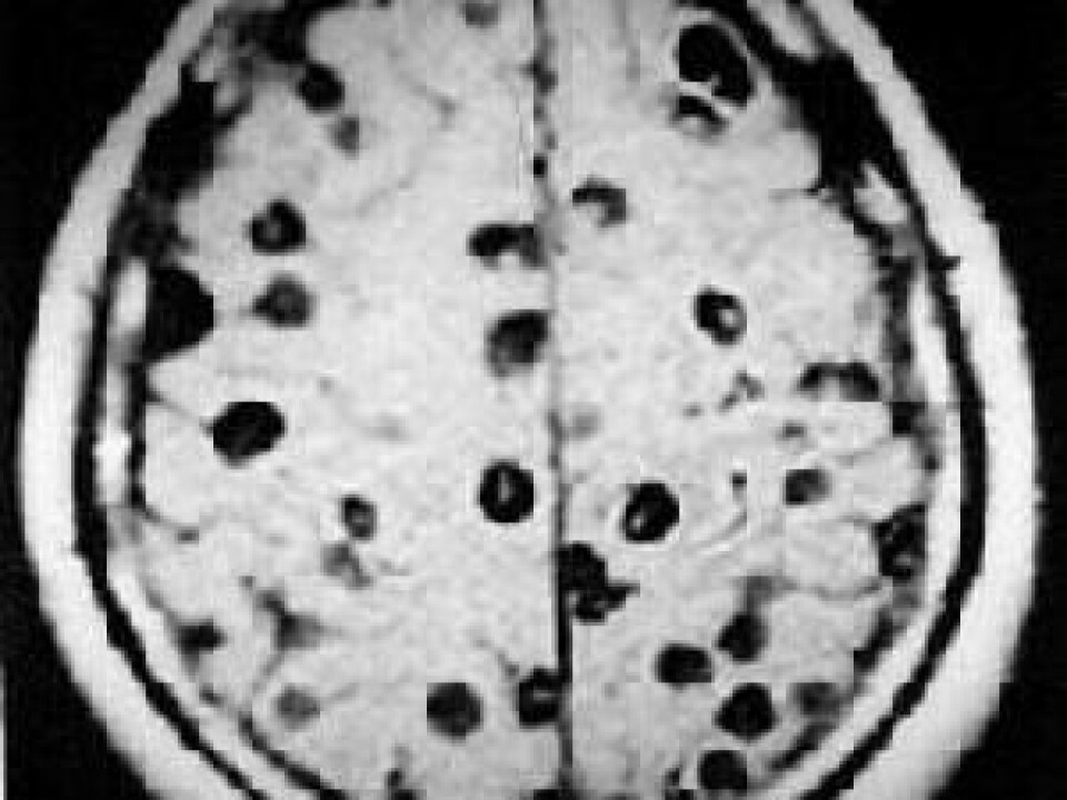 A brain scan showing cysts (dark, circular areas).