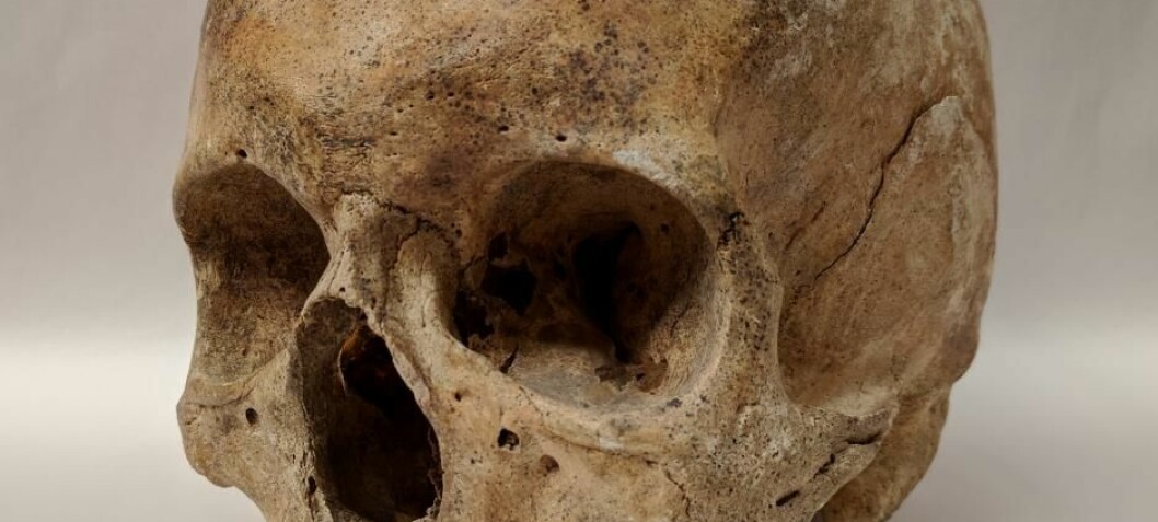 Leprosy DNA extracted from medieval skeletons in Denmark