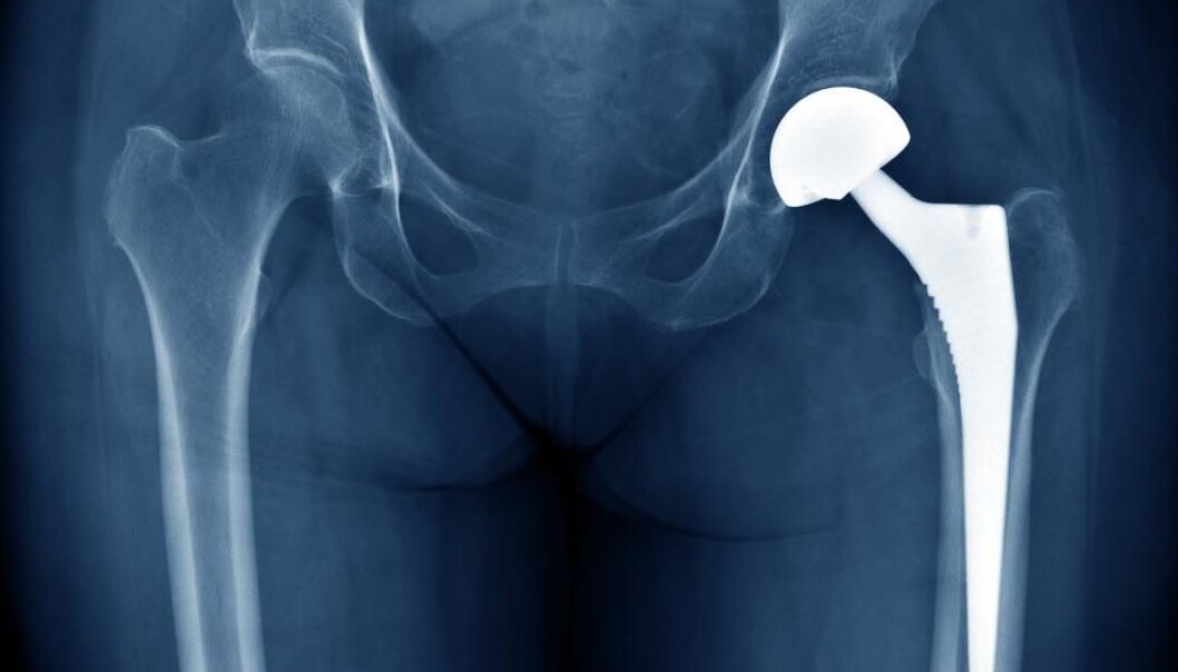 Implants become colonised by bacteria. They might even protect against infections. (Photo: Shutterstock) Implants become colonised by bacteria. They might even protect against infections. (Photo: Shutterstock)