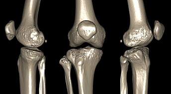Considering knee surgery? Read this first