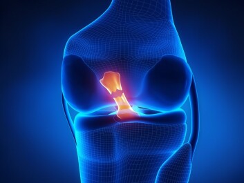Torn anterior cruciate ligament is a common injury in sport. (Image: CLIPAREA/Shutterstock.com) Torn anterior cruciate ligament is a common injury in sport. (Image: CLIPAREA/Shutterstock.com)