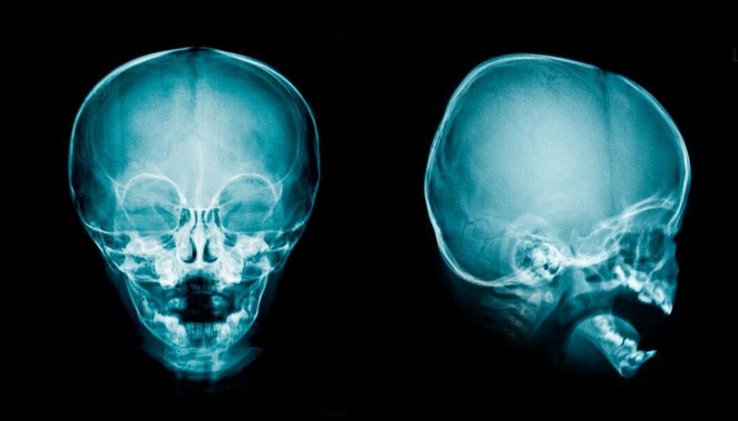 A protein found in the choroid plexus is responsible for at least half of the cerebrospinal fluid production in mice. The discovery could help find a non-surgical treatment for hydrocephalus, also known as water on the brain. (Photo: Shutterstock) A protein found in the choroid plexus is responsible for at least half of the cerebrospinal fluid production in mice. The discovery could help find a non-surgical treatment for hydrocephalus, also known as water on the brain. (Photo: Shutterstock)