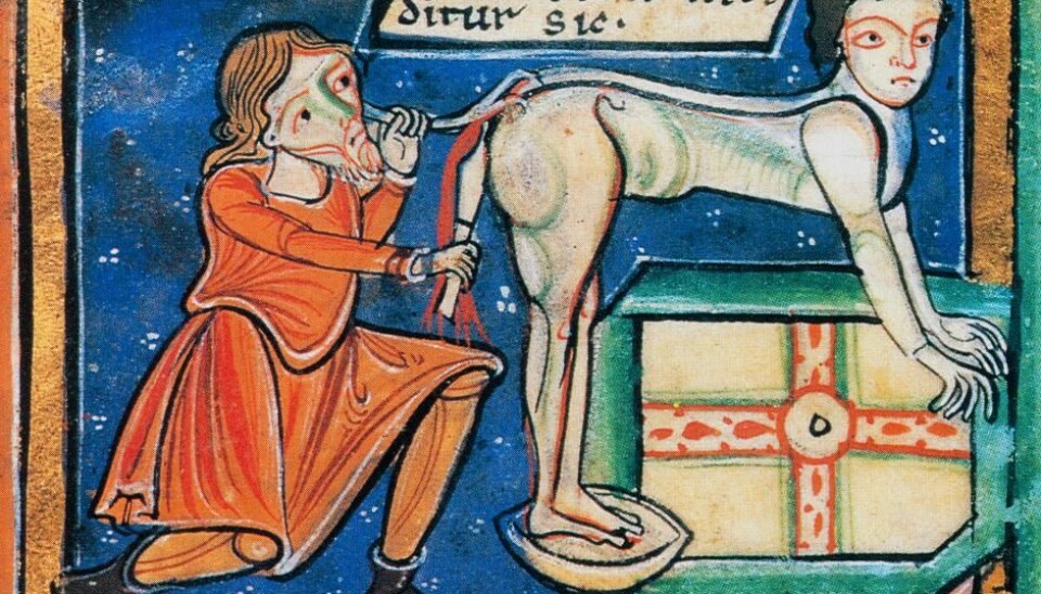 Medieval surgery for haemorrhoids. The surgeon holds in his left hand an instrument to visualise and secure the haemorrhoids. In his right hand he holds a knife to cut them away. The picture is from c. 1200 ACE. (Image: The British Library).