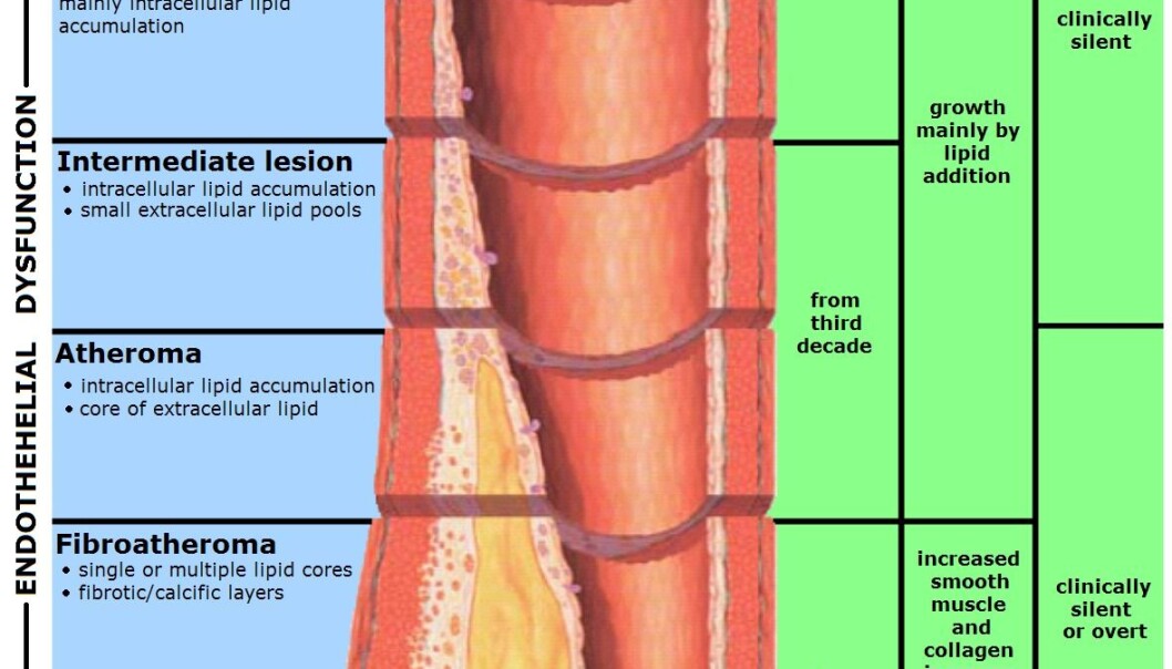 Atherosclerosis is a condition where an artery wall thickens as a result of the accumulation of fatty materials such as cholesterol (Illustration: Wikimedia Commons) Atherosclerosis is a condition where an artery wall thickens as a result of the accumulation of fatty materials such as cholesterol (Illustration: Wikimedia Commons)