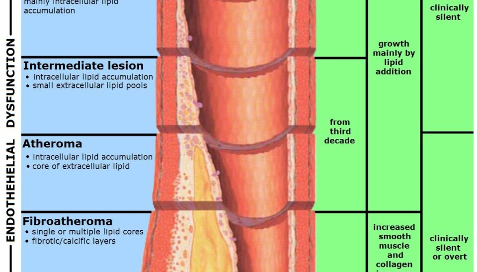 Atherosclerosis is a condition where an artery wall thickens as a result of the accumulation of fatty materials such as cholesterol (Illustration: Wikimedia Commons)