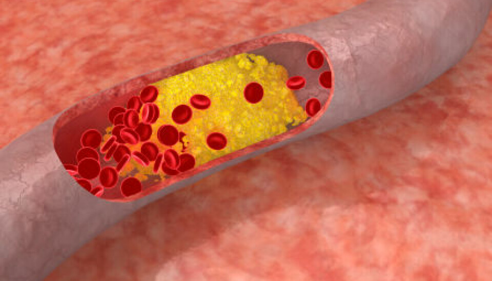 Cholesterol plaque in artery. (Photo: Istockphoto)