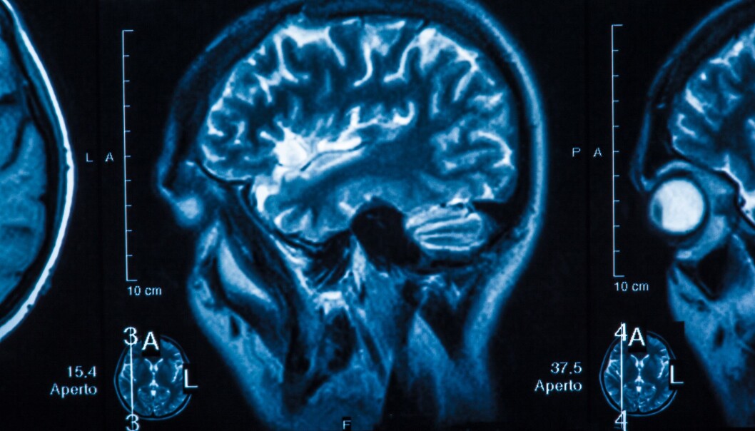 A substance in the brain that alerts the body to inflammation and disease can also affect our weight. (Illustration: Colourbox) A substance in the brain that alerts the body to inflammation and disease can also affect our weight. (Illustration: Colourbox)