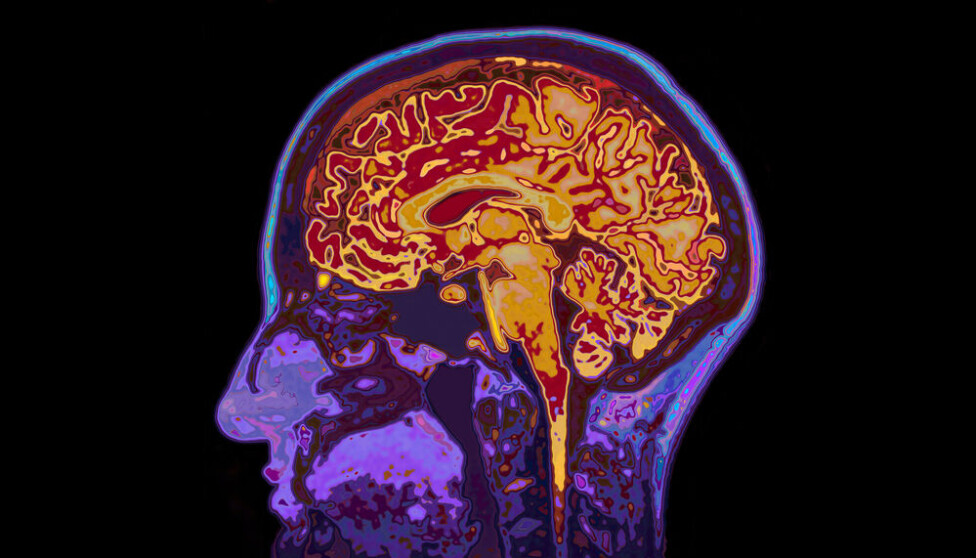 2D MRI scan of a head. New research has improved our ability to do a precise reconstruction of the brain using MRI-scan