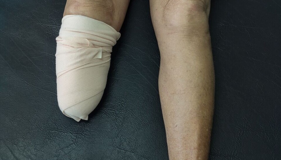 Phantom pain is experienced as real pain. It is, however, obviously hard to treat.