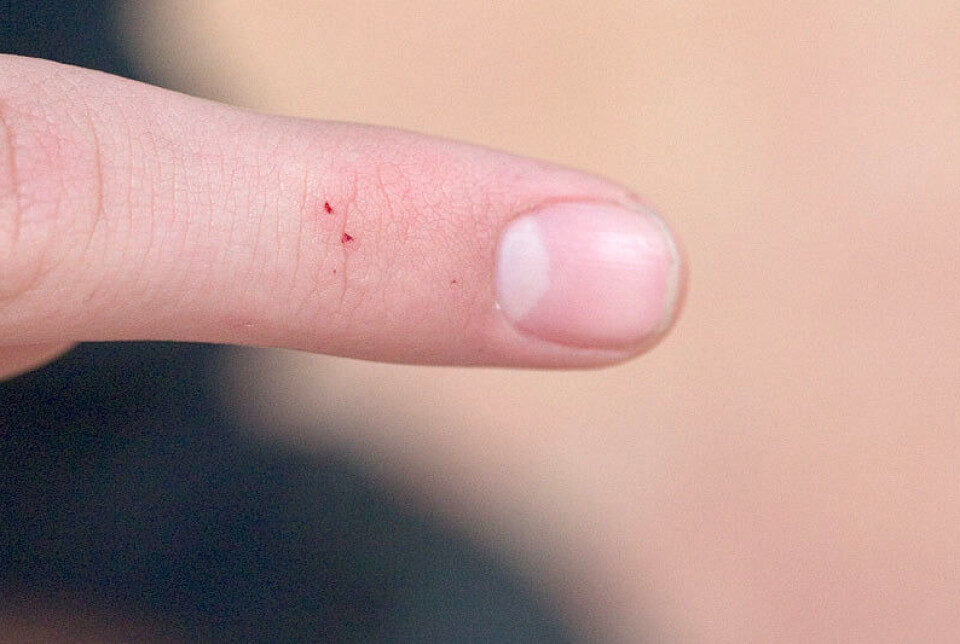 Black widow spider bite.