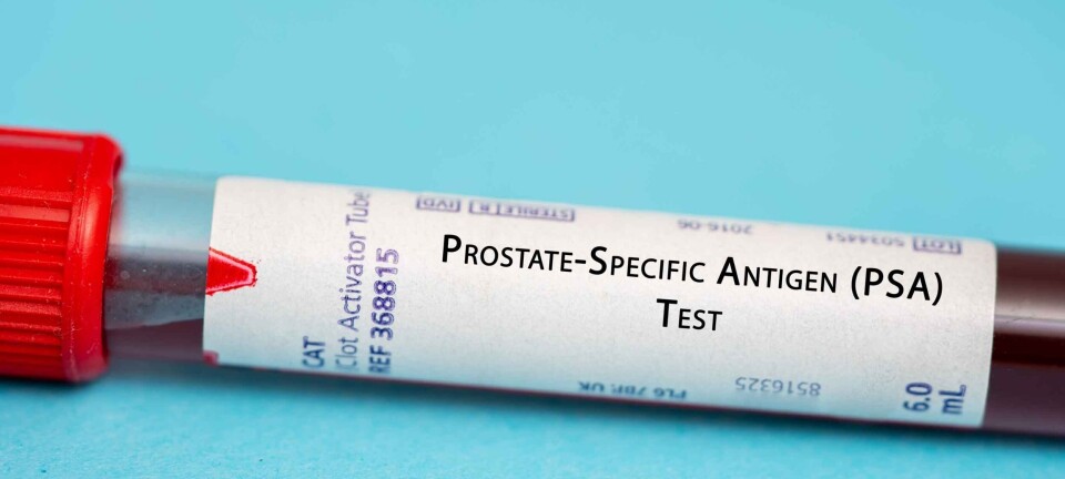 A Sweet Breakthrough in Prostate Cancer Screening