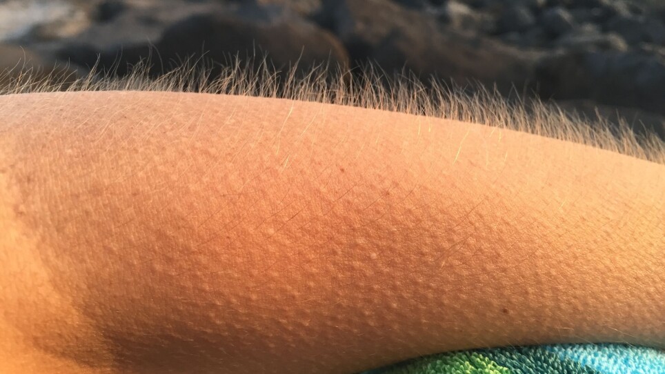 Why do we get goosebumps? 'A reminder that we're animals'